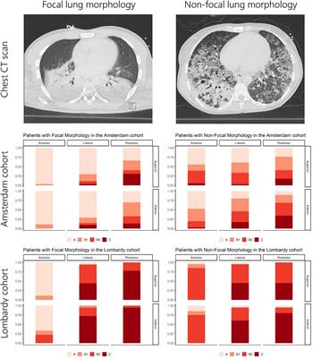 Lung Ultrasound Assessment of Focal and Non-focal Lung Morphology in Patients With Acute Respiratory Distress Syndrome